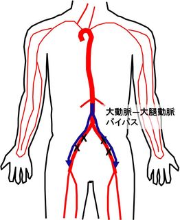 大動脈ー大腿動脈バイパス（青い矢印の部分が人工血管となります）