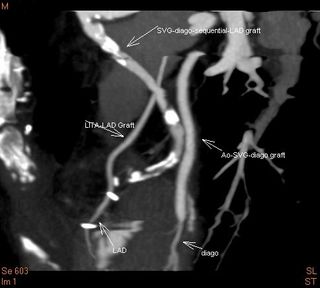 術後の冠動脈ＣＴ検査で２本の新バイパスがきれいに写っています