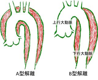 Aortic Dissect