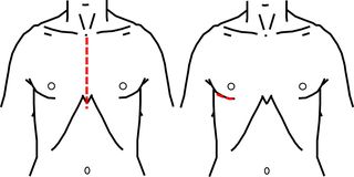 通常の創（左側）とポートアクセス法ミックス手術での創（右側）。通常の方法では胸骨という骨を切りますが、ポートアクセス法では骨は切りません。