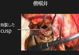 再手術のときの所見。昔植え込まれた生体弁が長年の疲れで破れて逆流を起こしていました