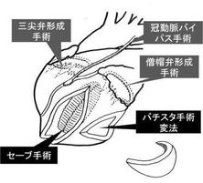 虚血性心筋症・虚血性僧帽弁閉鎖不全症に対する複合手術。海外のジャーナルにも掲載され当時の新聞でも報道されました。