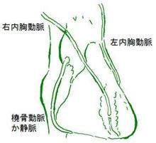 冠動脈バイパス手術のできあがりの一例。内胸動脈は動脈硬化を防ぐホルモンを作るため心臓の冠動脈よりも硬化しにくいためバイパス手術のあとは長持ちしやすくなります