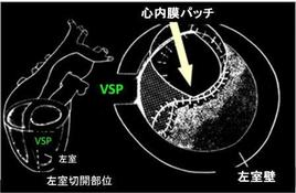 左室を治せば孔(VSP)は結果として閉じる、これが心筋梗塞部除外法のポイントです。ゴルフでいえば良いスイングをすれば結果としてボールは良く飛ぶ、というのと似ています。