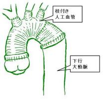 ステップワイズ法で行う弓部大動脈全置換術のシェーマです