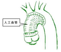 典型的な大動脈解離の手術後の姿です。近位弓部大動脈置換術（ヘミーアーチ置換）とよびます