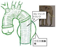 弓部大動脈全置換術にエレファントトランクを加えるとこうなります