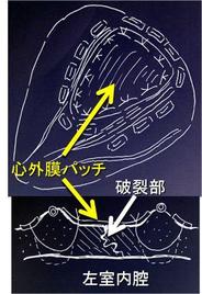 私たちが開発した左室破裂用左室修復法です。ブローアウト型の厳しい破裂でも救命した経験があります