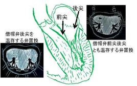 僧帽弁置換術といえども、乳頭筋などを温存すれば、心臓の力は保てます