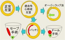 左室形成術にはそれぞれの特徴や利点があります。オーバラップ手術にも時に得難いメリットがあります。