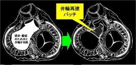 大動脈基部から僧帽弁輪にかけて膿瘍（うみがたまること）ができた時に心臓を再建する方法