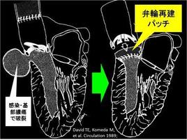 大動脈基部膿瘍は感染性心内膜炎の中でも重症に入ります。徹底した除菌と確実な再建が必要だからです