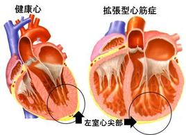 拡張型心筋症の左心室は単に大きく拡張するだけでなく、形が丸くなります。左心室にとって丸い形はパワーの上で不利であることが知られています