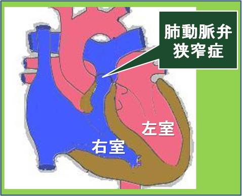 肺動脈弁の位置を示します。その肺動脈弁が狭くなると、右室に無理がかかり、二次的な問題も発生します