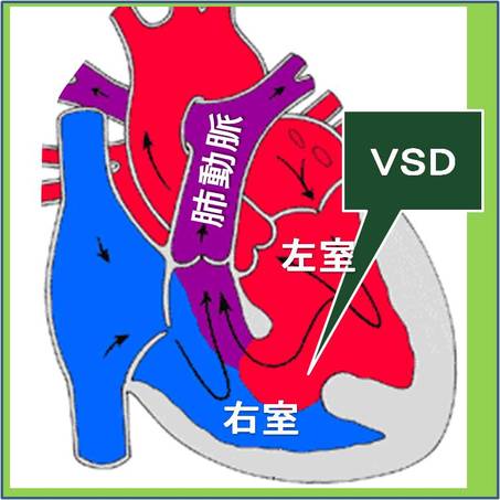 心室中隔欠損症(略称VSD)のおおよその位置を示します。おおよそというのはVSDに４タイプがあり、位置が少しずつちがうからです。治し方も違います。