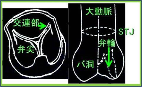 バルサルバ洞の位置をしめします。ここがこぶのように膨らむと破れる危険ができたり大動脈弁に支障をきたしたりします