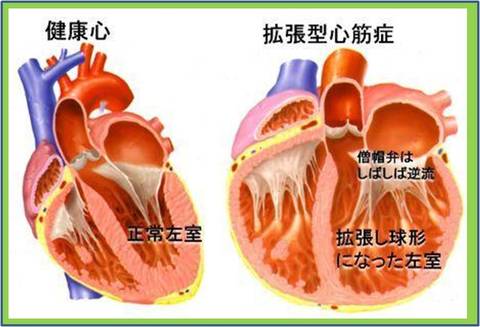 拡張型心筋症(右図)では健康心(左図)とくらべて丸く大きくなります。そのために心臓の力が落ちたり、僧帽弁が逆流して一層心不全が強くなったりします