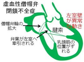 虚血性僧帽弁閉鎖不全症、略して虚血性MRは弁膜症の形をした左室疾患です。この本質を踏まえて手術・治療すれば修復できる場合が多く、人工弁はほぼ不要です。