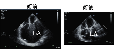 心房縮小メイズ手術によって巨大左房(LA)もかなりきれいな姿になり、心房細動も治りました