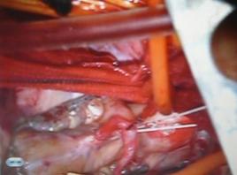 心臓の下側の冠動脈にバイパスを縫いつけているところです
