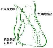 オフポンプ冠動脈バイパス手術の出来上がり図です