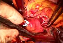 ウシ心膜弁(これも代表的生体弁です)を大動脈弁の位置に入れたところです