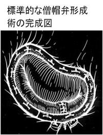 典型的な僧帽弁形成術の仕上がりの様子です