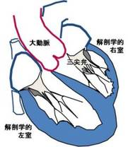 修正大血管転位症では弱い右心室が全身への血液供給を任され無理が生じます