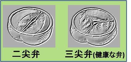 大動脈二尖弁と三尖弁の違いを示します