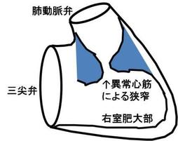 ７ｂ 右室二腔症 重症になると突然死の危険性も しかし 19年最新版 心臓外科手術情報web