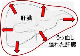 強い三尖弁閉鎖不全症が起こると肝臓がうっ血し徐々に肝硬変になってしまいます