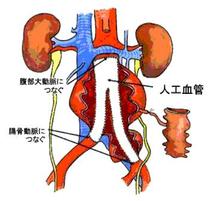 腹部大動脈瘤は手術で99％以上治ります。手術できないときはステントグラフトという選択肢もあります。