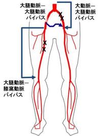 下肢動脈の血行再建のためのバイパス手術を示します