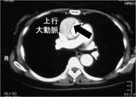 大動脈解離（A型）のCT写真です。大動脈の壁が裂け（矢印）、内側が２つにわかれているのが見えます。