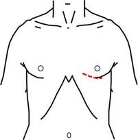 ミッドキャブ手術の左小切開創を示します