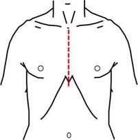 胸骨正中切開を赤い線で示します