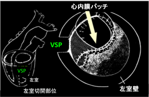 図 VSP手術