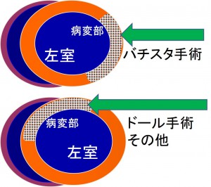 バチスタ手術とその他の左室形成術