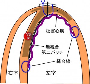 VSP current surgery