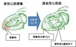 図　梗塞後リモデリング