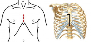 Lower Hemisternotomy4