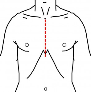 medianSternotomy