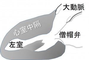 mid-ventricular HOCM