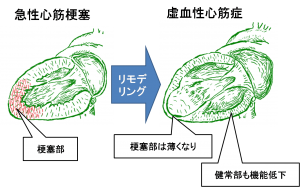 図　梗塞後リモデリング