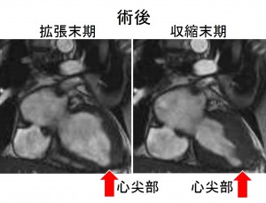 ApicalHCMpostop