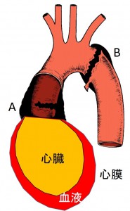 AortaAndTamponade